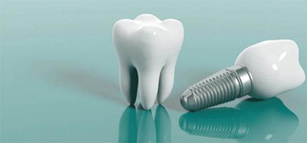 دندان پزشکی اقساطی برترین راه برای مدیریت هزینه ایمپلنت دندان